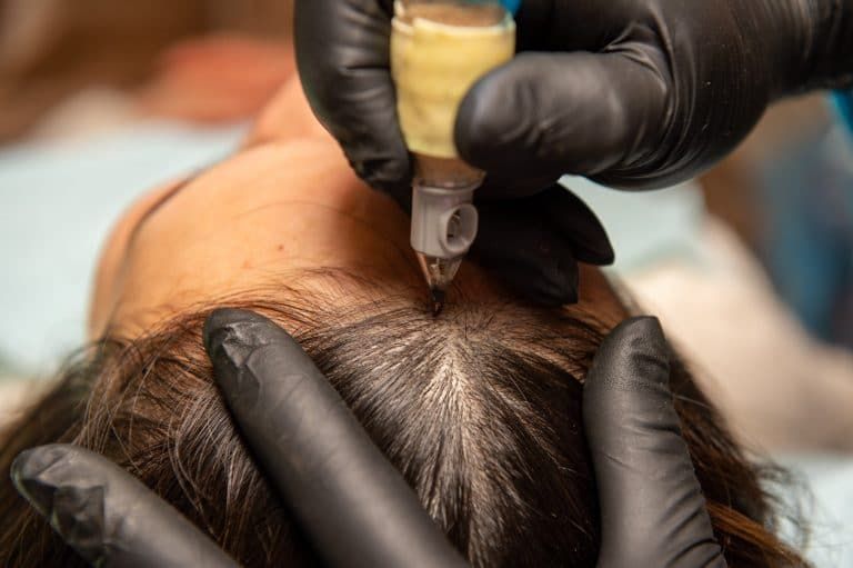 bsytds|Scalp Micropigmentation: Benefits, Procedure, and Aftercare