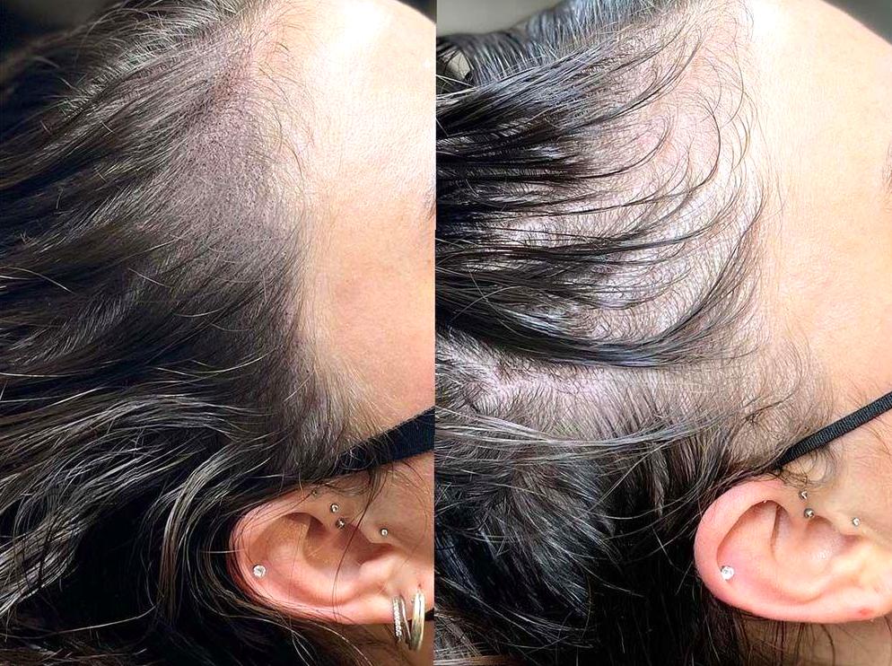 Scalp Micropigmentation: A Solution for Thinning Hair and Hair Loss